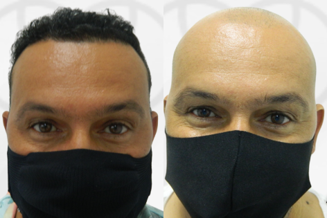 Antes e Depois Dr. Paulo 1