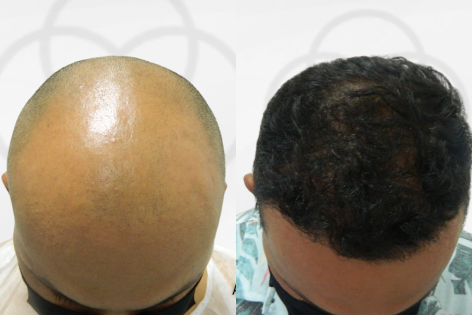 Antes e Depois Dr. Paulo 2