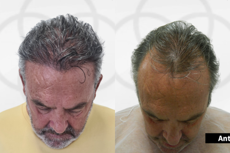 Antes e Depois Dr. Paulo 4