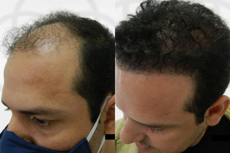 Antes e Depois Dr. Paulo 5