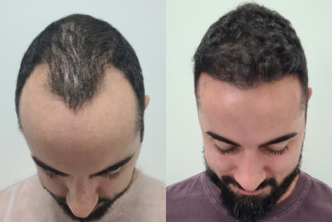 Antes e Depois Dr. Paulo 6