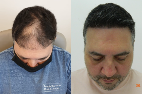 Antes e Depois Dr. Paulo 7