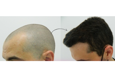 Antes e Depois Dr. Paulo 8 2x