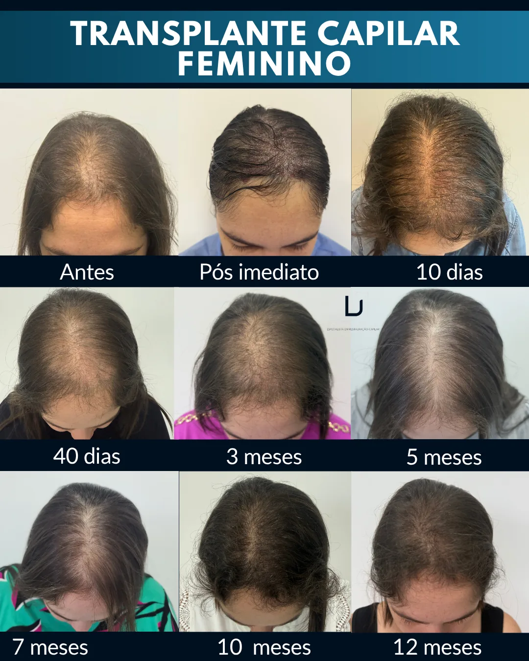 Transplante capilar feminino: evolução do antes a 12 meses