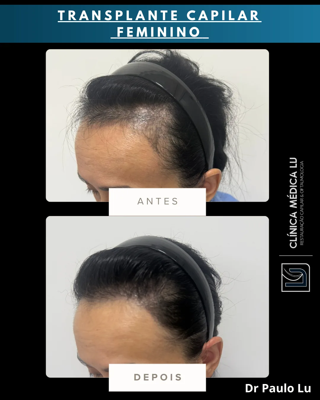 Transplante capilar feminino antes e depois