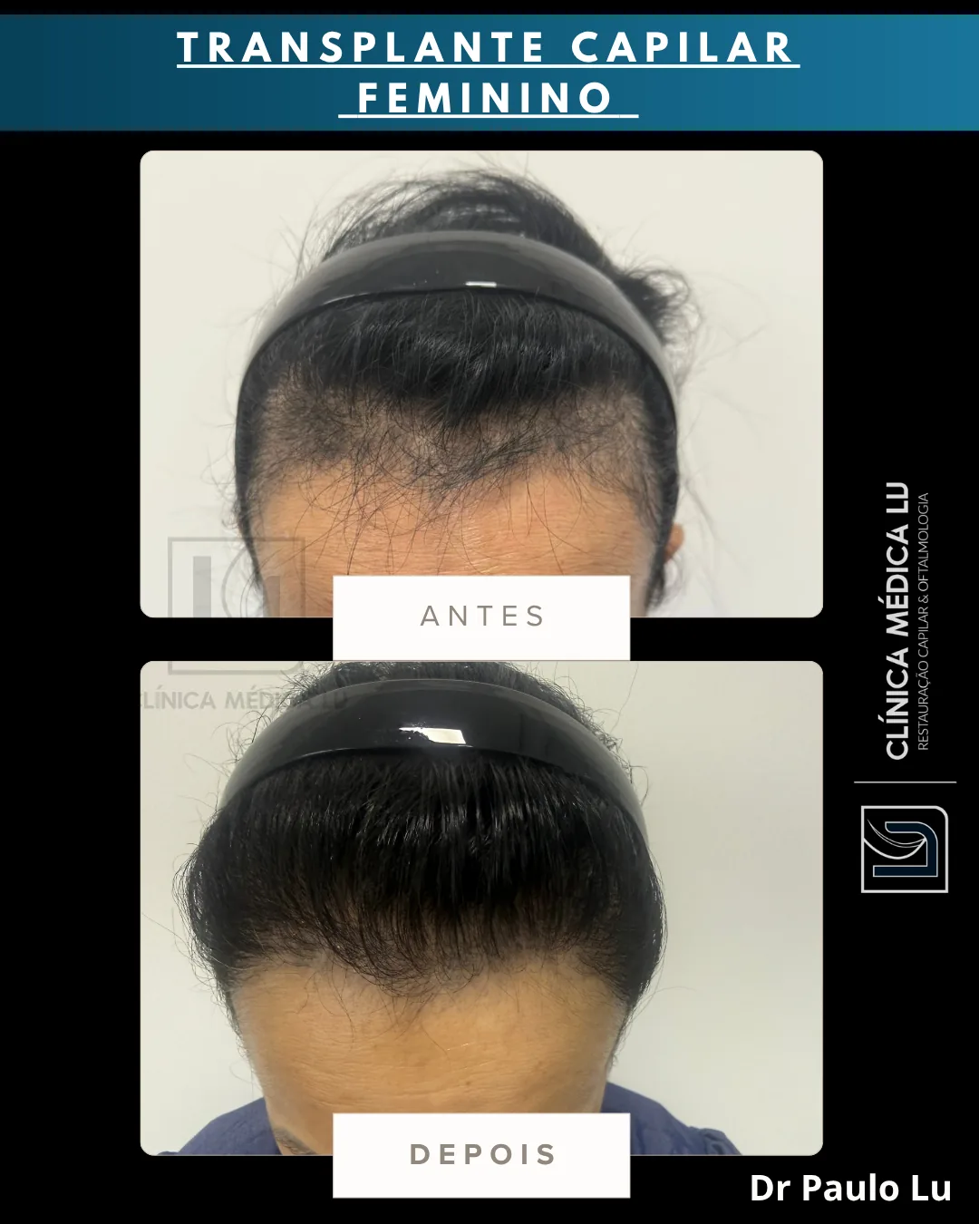 Transplante capilar feminino antes e depois