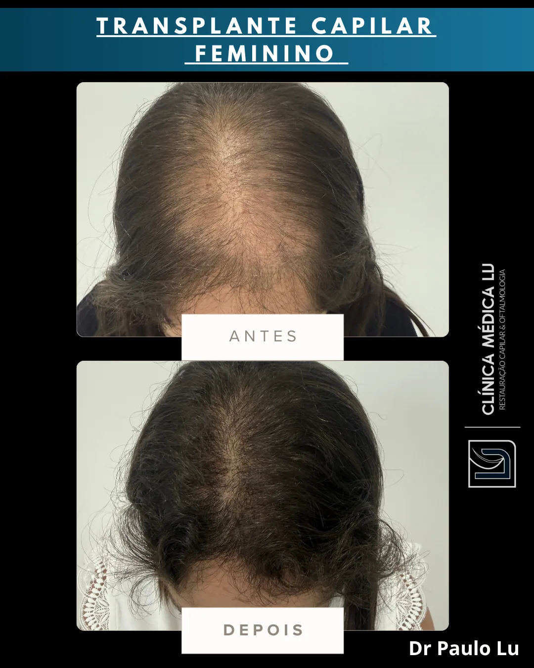 Transplante capilar feminino antes e depois