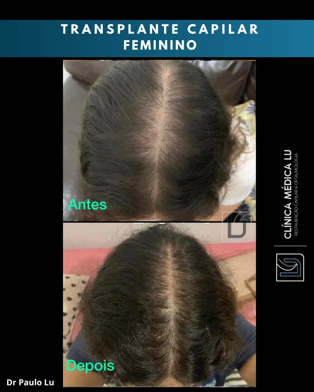 Transplante capilar feminino antes e depois