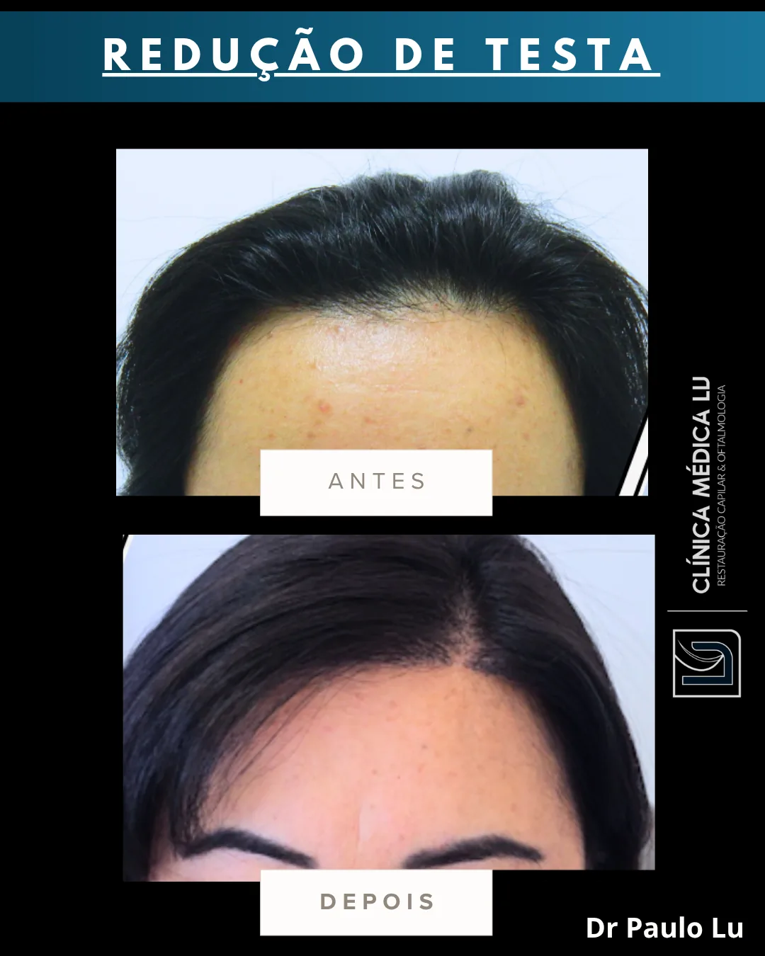Redução de testa em mulher antes e depois