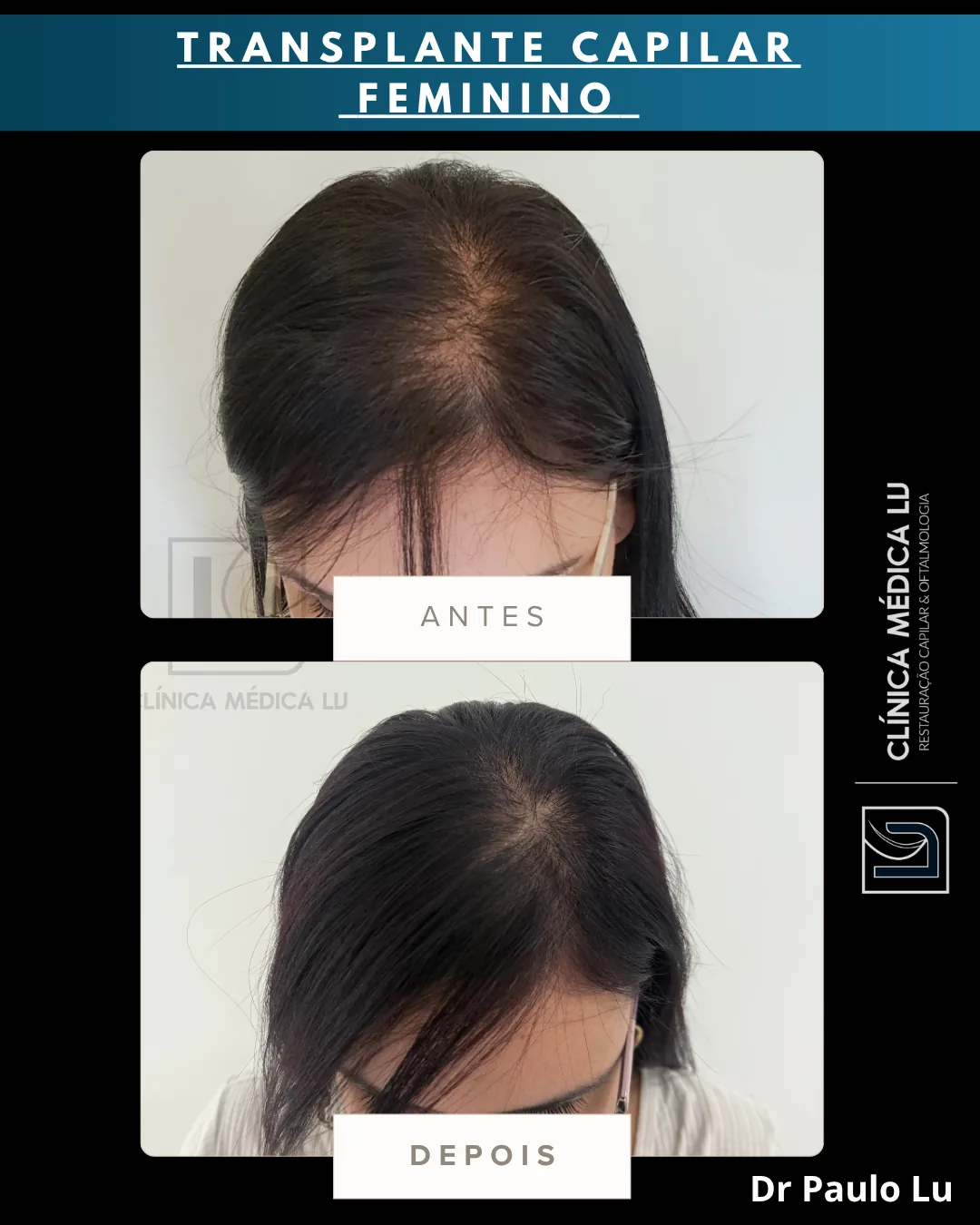Transplante capilar feminino antes e depois