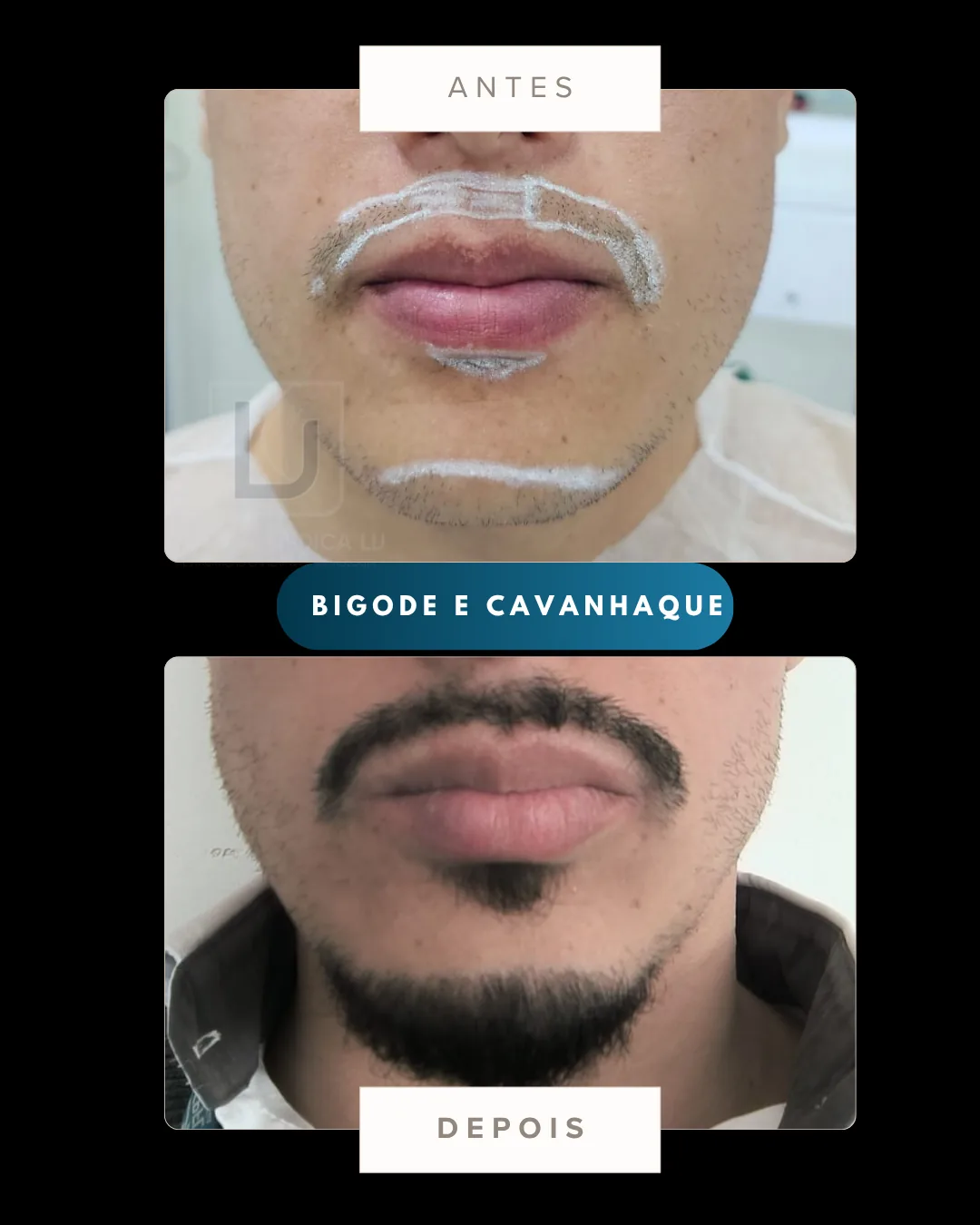 Transplante de barba no bigode e cavanhaque antes e depois