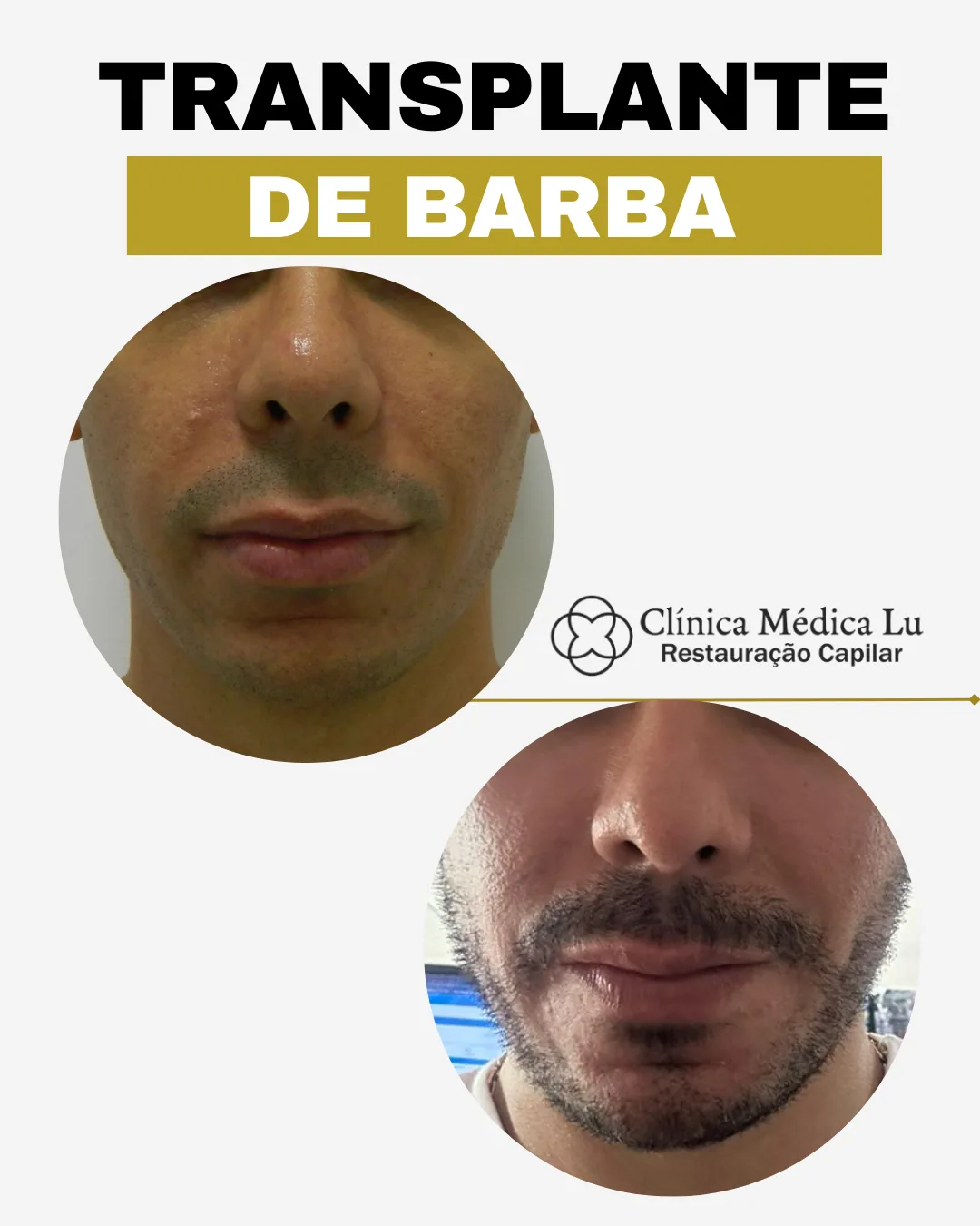 Transplante de barba antes e depois