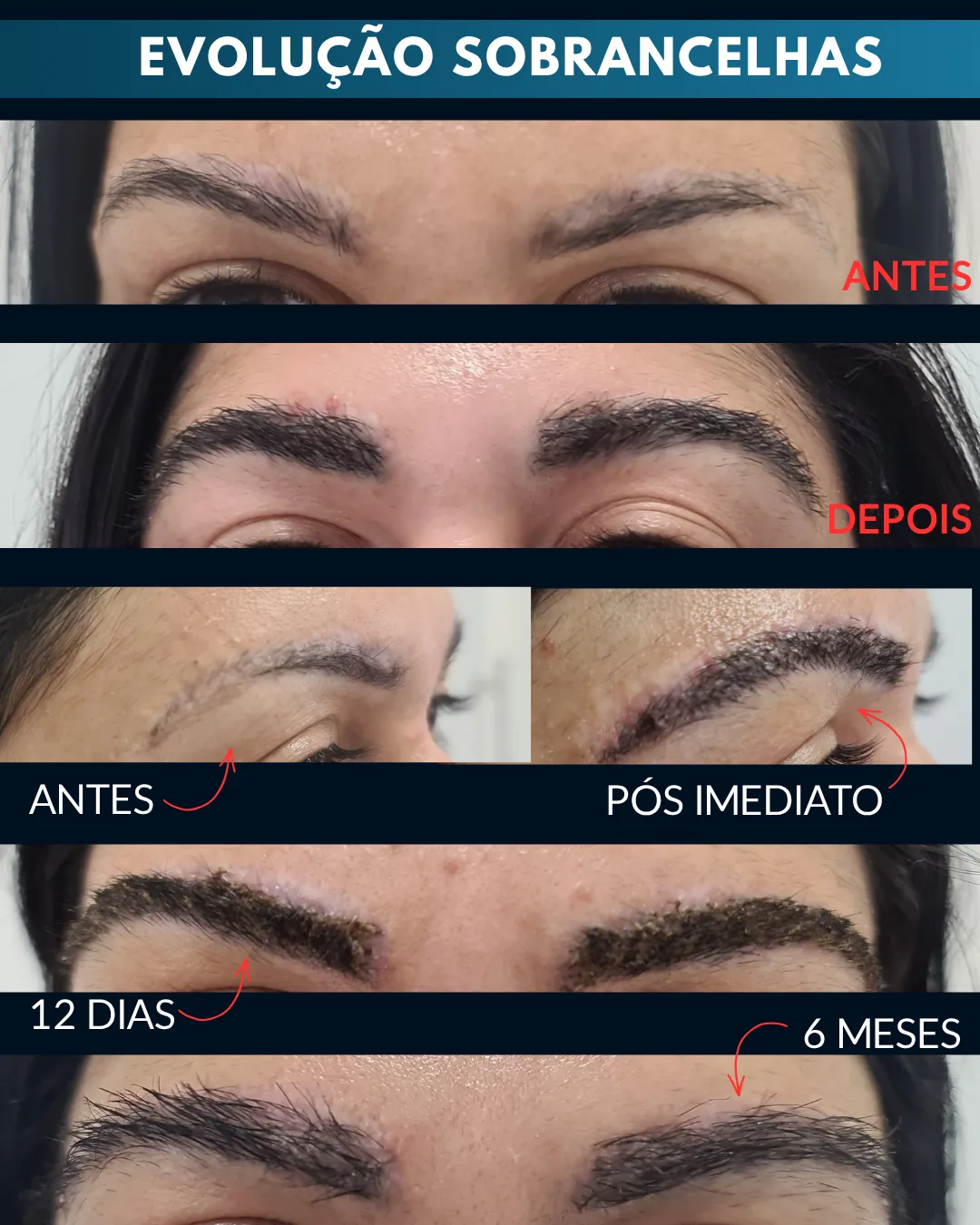 Evolução do transplante de sobrancelhas