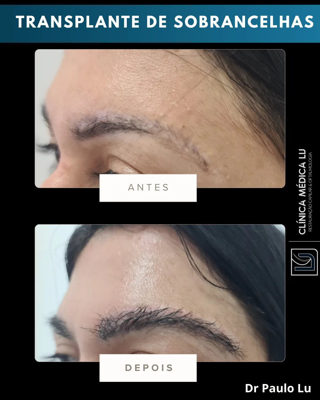 Transplante de sobrancelhas antes e depois
