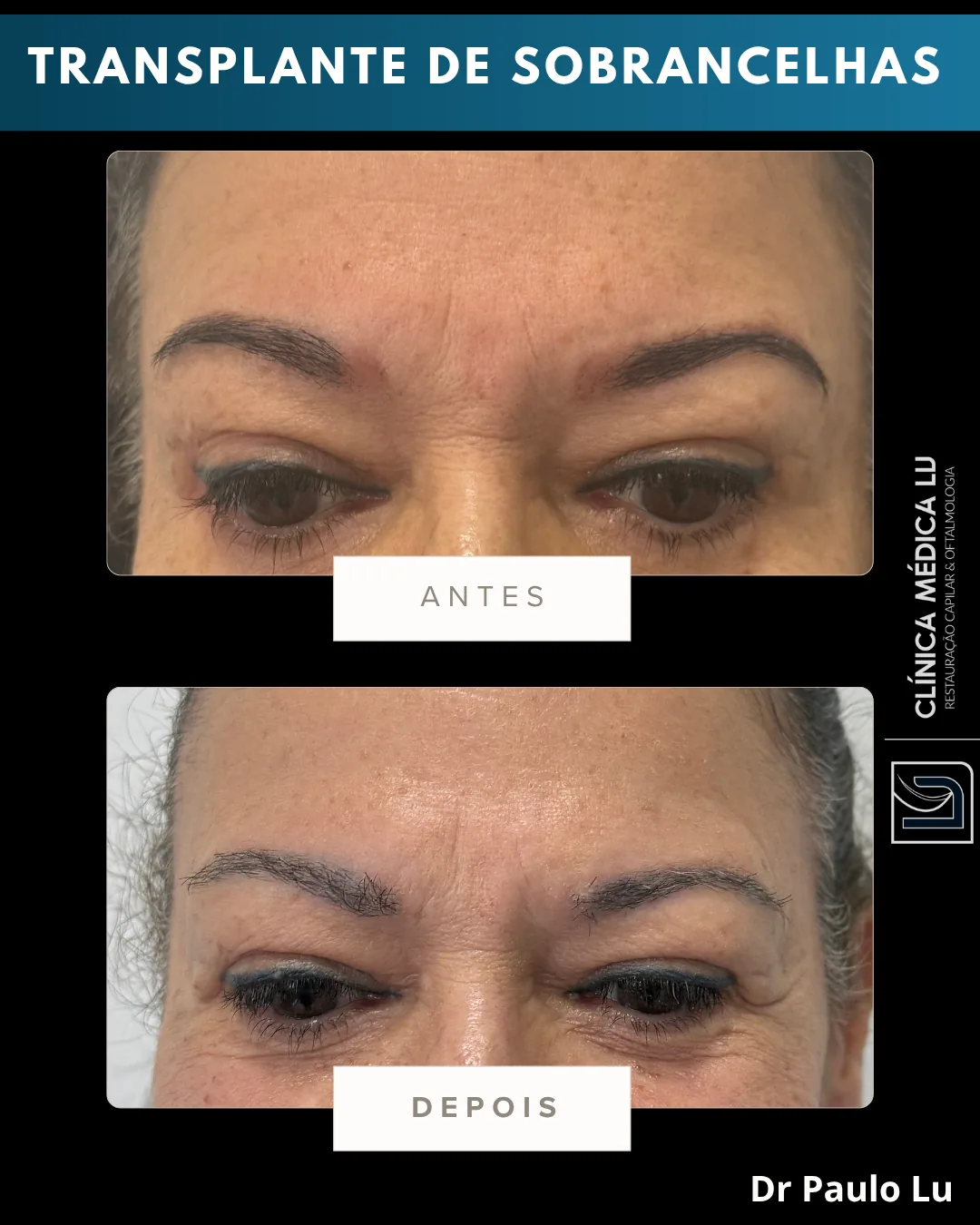 Transplante de sobrancelhas antes e depois