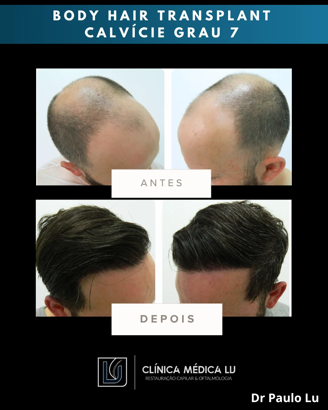 Body hair transplant em calvície grau 7 antes e depois