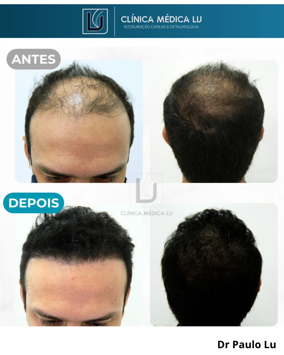 Transplante com pelo corporal antes e depois