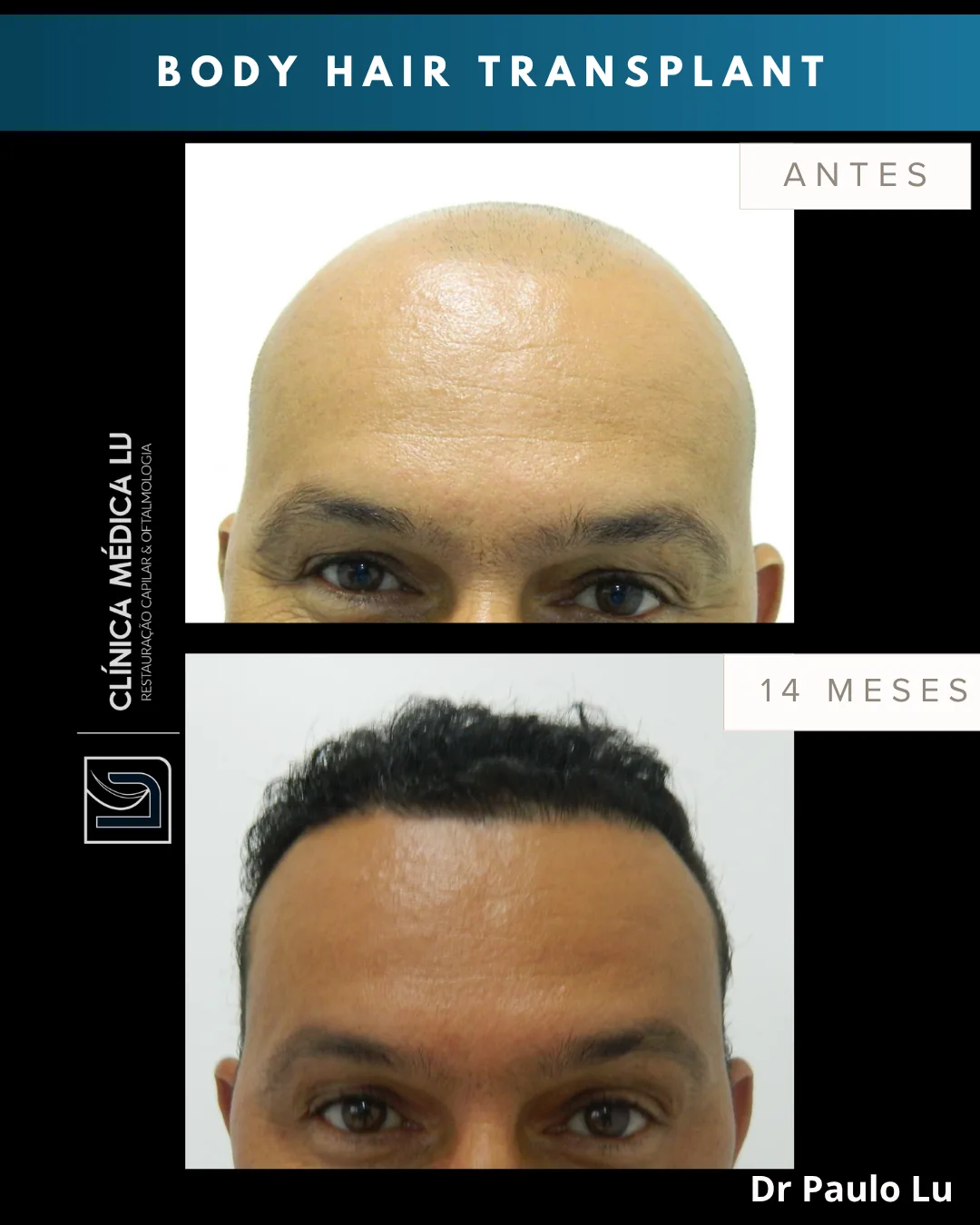 Body hair transplant antes e 14 meses depois