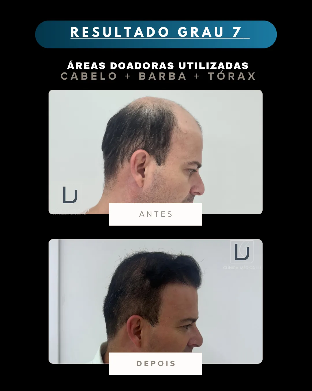 Resultado grau 7 com áreas doadoras cabelo, barba e tórax