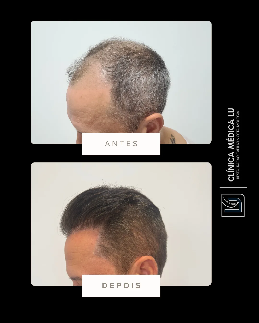Transplante com pelo corporal antes e depois