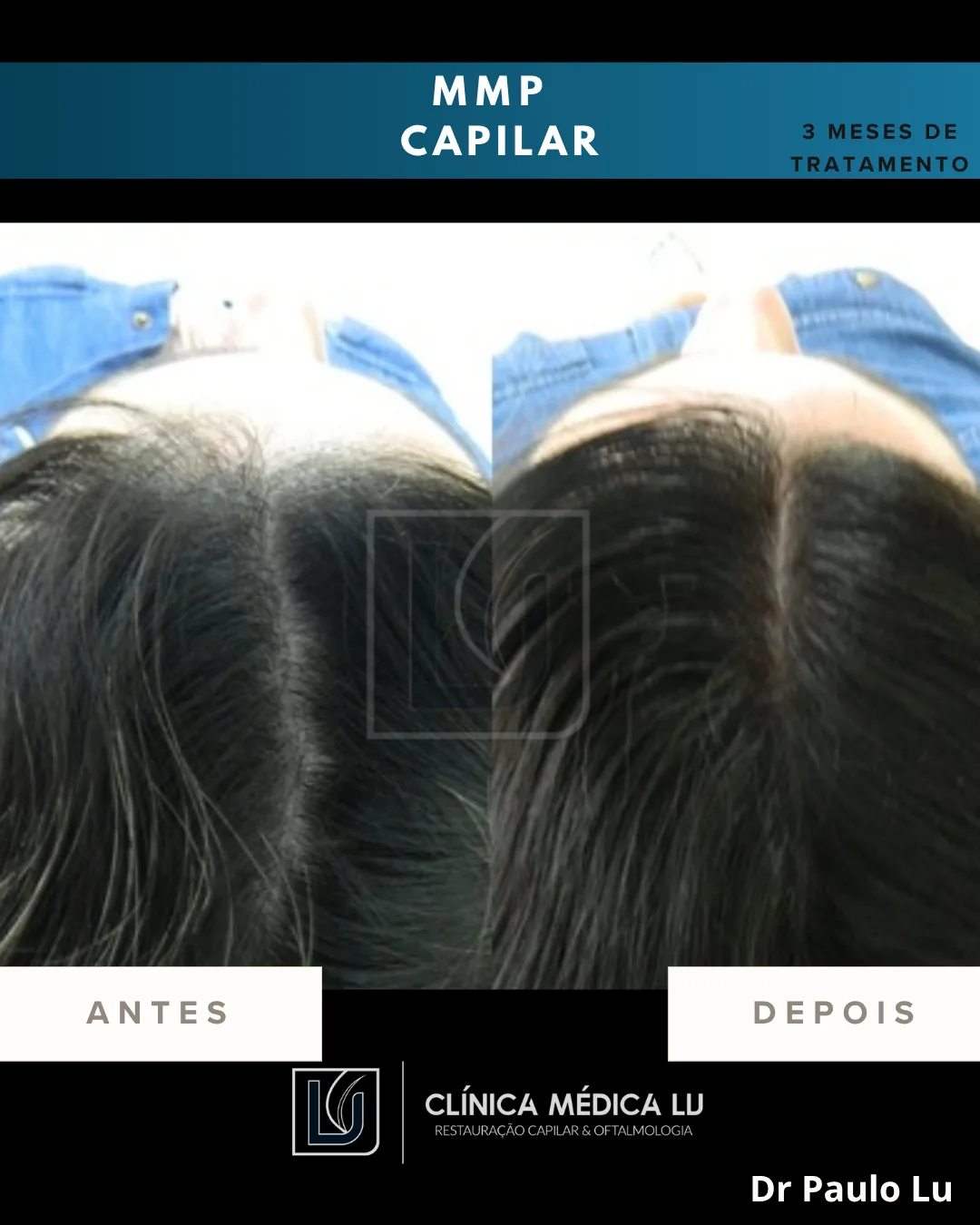 Tratamento capilar MMP antes e depois