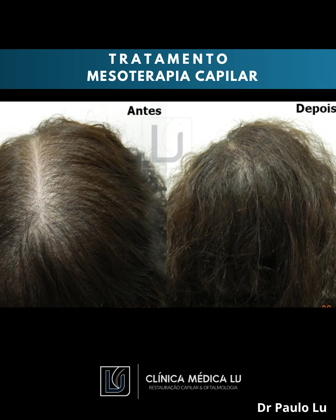 Mesoterapia capilar antes e depois