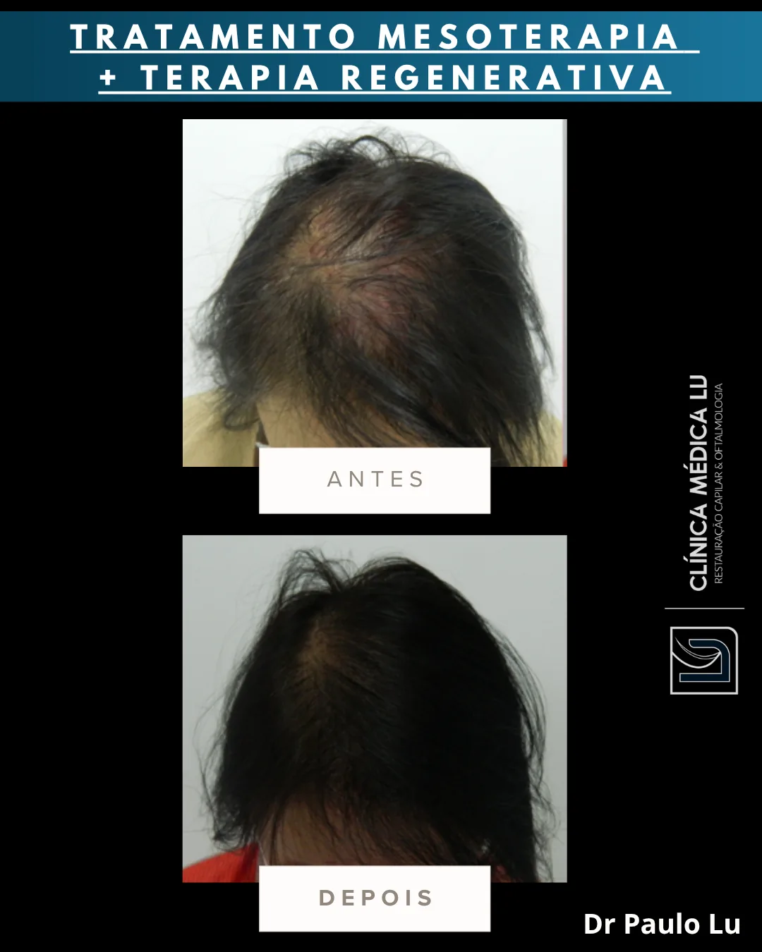 Tratamento com mesoterapia e terapia regenerativa antes e depois
